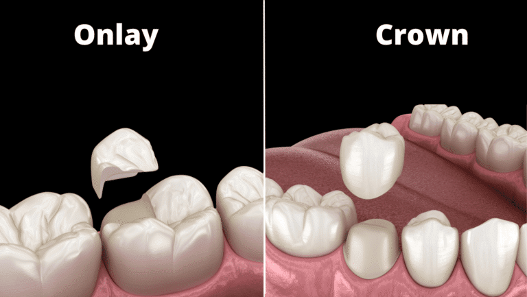 What’s the Difference between Onlay and Crown