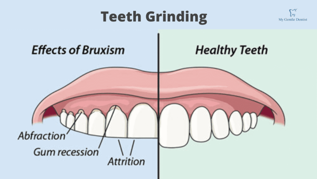 Reasons You Should Get a Night Mouth Guard to Protect Your Teeth