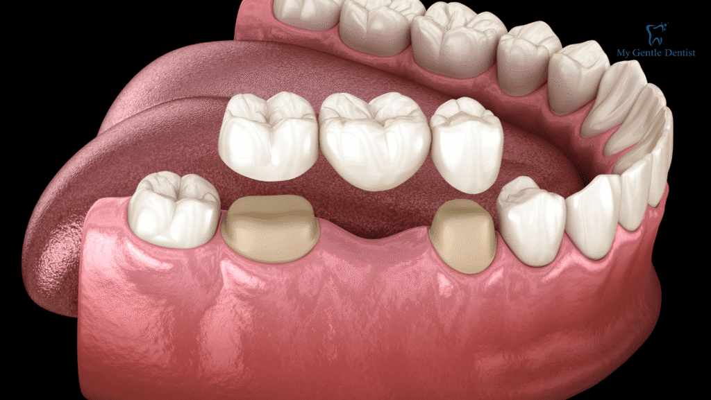 What are Dental Crowns and Bridges? What are Dental Crowns and Bridges?