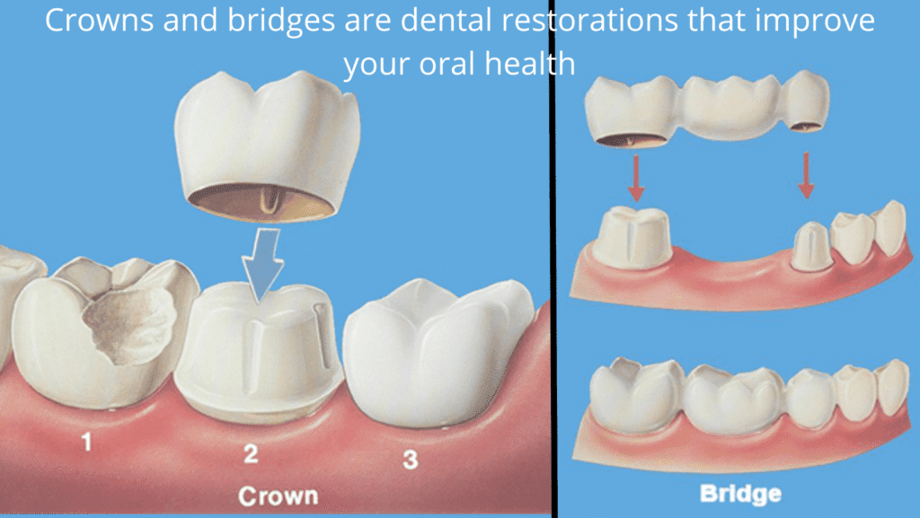 What are Dental Crowns and Bridges? What are Dental Crowns and Bridges?