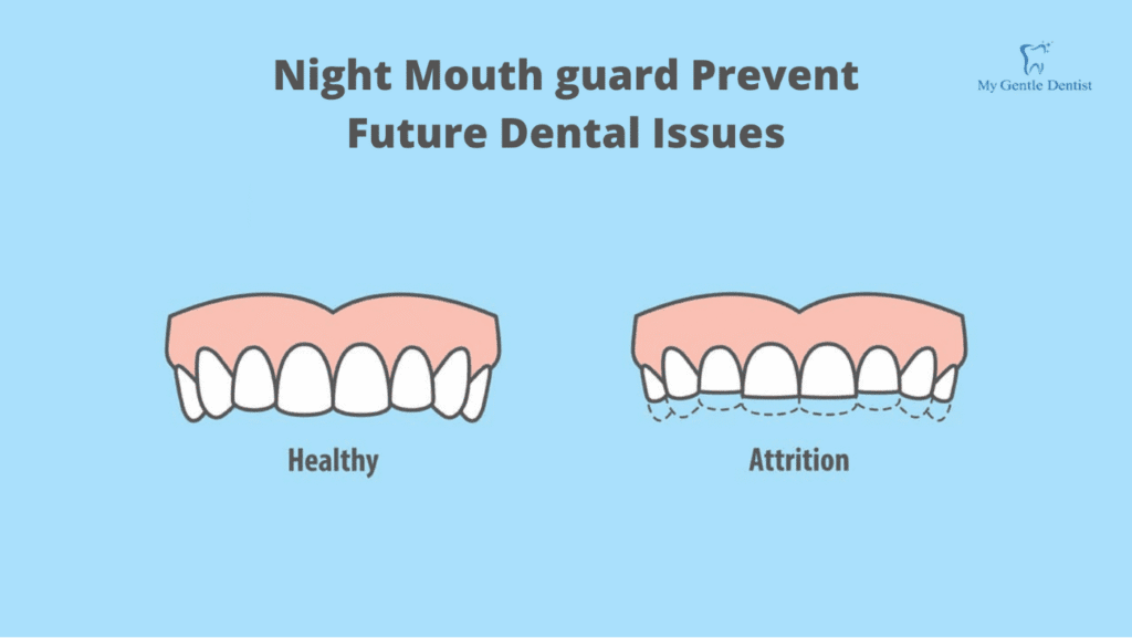 Reasons You Should Get a Night Mouth Guard to Protect Your Teeth