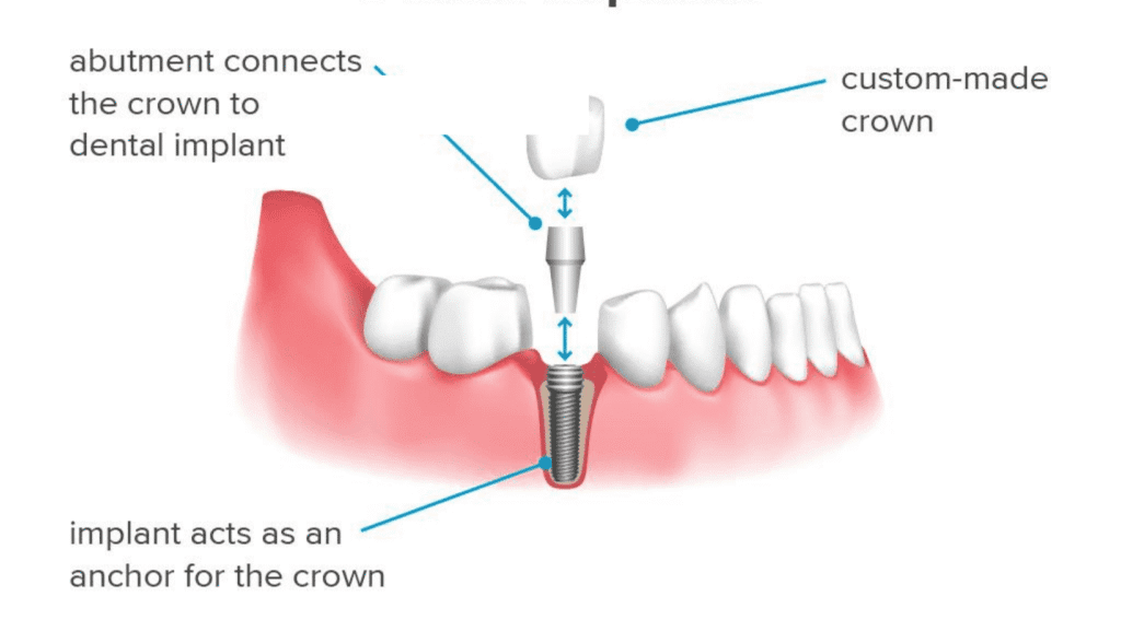 The Top 5 Reasons Why You Shouldn't Be Afraid Of Implant Surgery