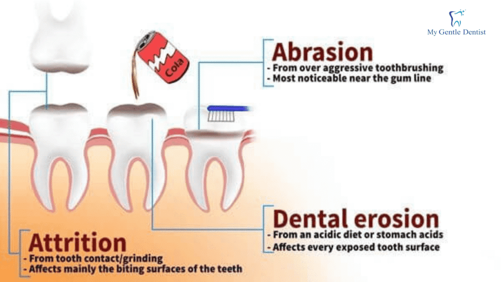 Tooth Wear: Causes, Prevention, and Treatment Tooth Wear: Causes, Prevention, and Treatment