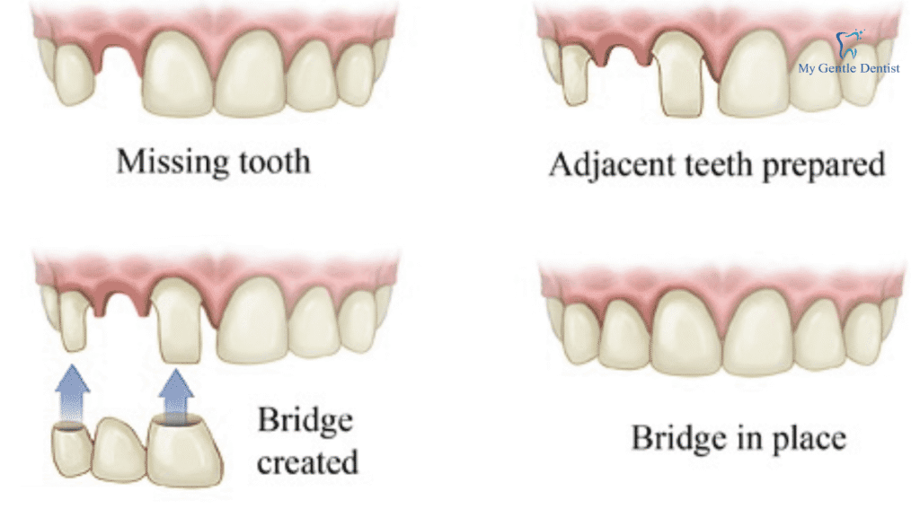 What are Dental Crowns and Bridges? Everything You Need to Know About Them