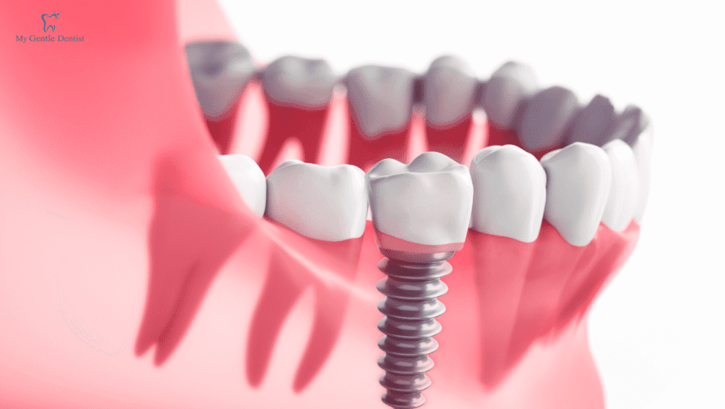 The Top 5 Reasons Why You Shouldn't Be Afraid Of Implant Surgery