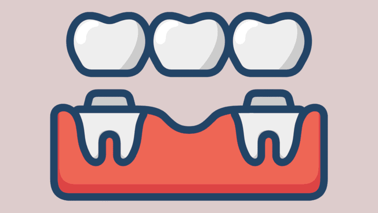 Dental Bridges