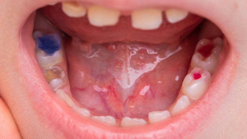 6 Crucial Times to Seek Emergency Dental Care Infections and Abscesses