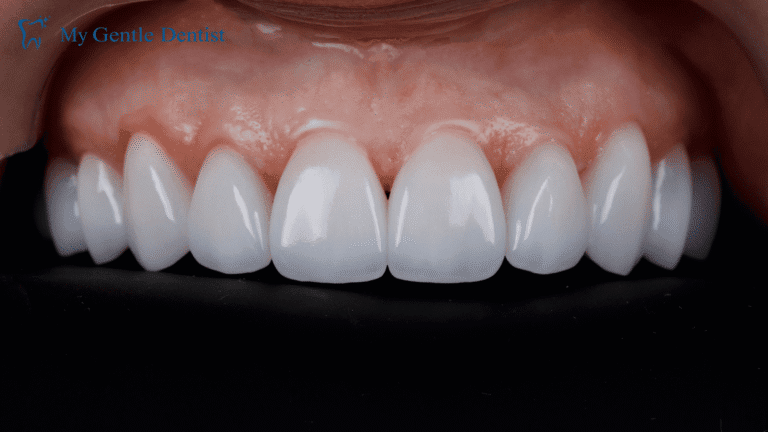 Dental veeners