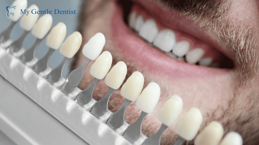 Dental Veneers Explained: Removal, Replacement Options, and Durability Longevity of Veneers