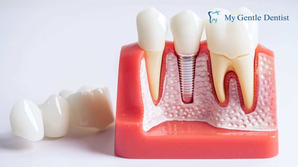How Much Do Dental Implants Cost in Brisbane?