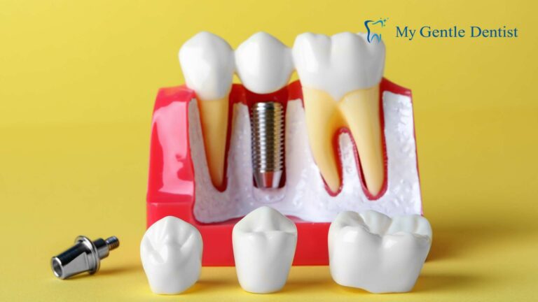 Why Choose Dental Implants Near Me for a Permanent Smile Solution?