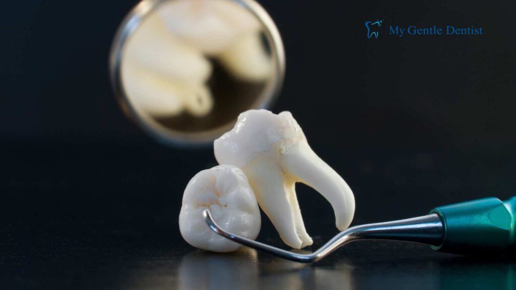 Is Tooth Extraction Cost Worth It? Key Points to Consider Tooth Extraction