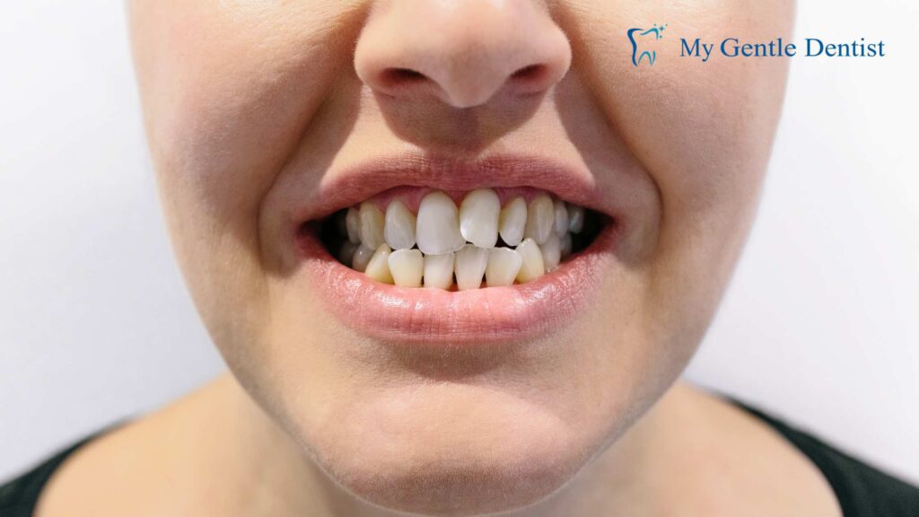 Top 5 Benefits of a Dental Bridge for Missing Teeth