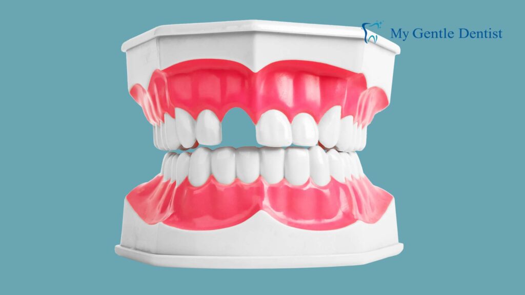 How Do Dental Implants Prevent Bone Loss in the Jaw? Tooth Loss?