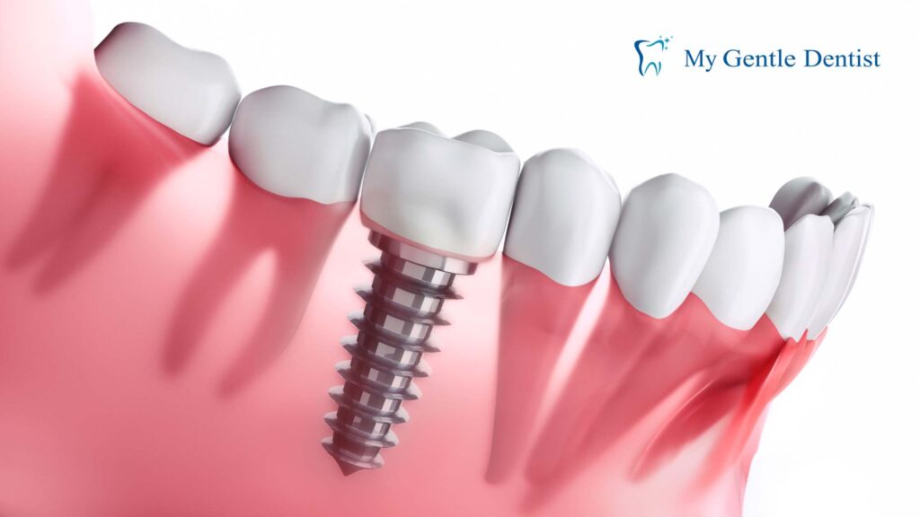 How Do Dental Implants Prevent Bone Loss in the Jaw? Dental Implants