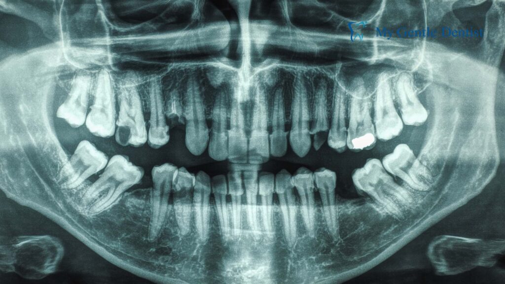 How Do Dental Implants Prevent Bone Loss in the Jaw? Jaw Bone Health