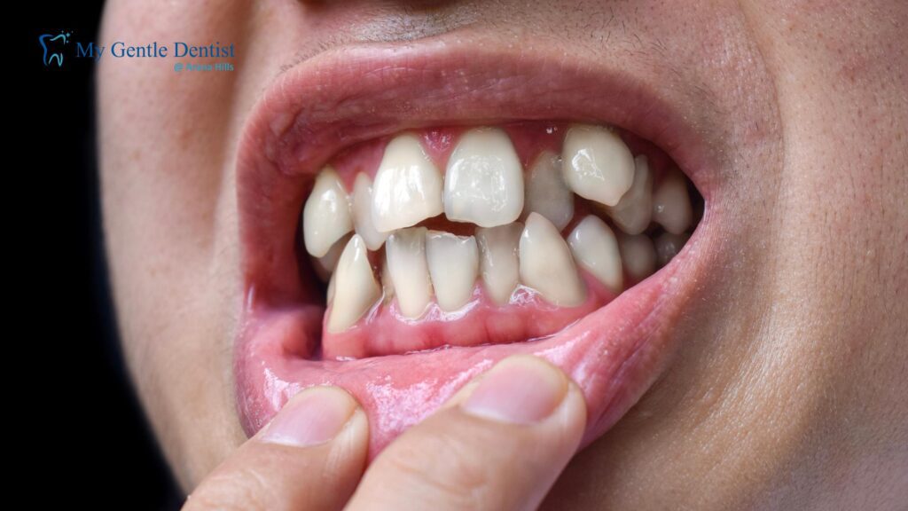 Porcelain Veneers for Crooked Teeth: Are They a Good Option?
