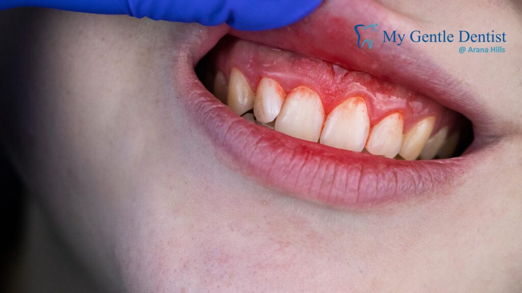 How Your Trusted Dentists in Mitchelton Proactively Prevent Gum Disease Gum Disease