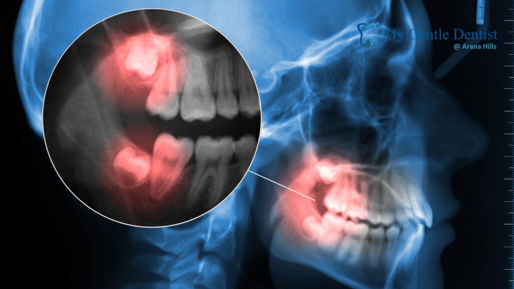 The Link Between Jaw Stiffness and Wisdom Tooth Pain Emergency Dentists
