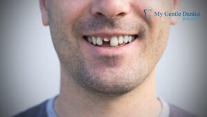 What Emergency Dentists Do When a Tooth Gets Knocked Out Emergency Dentists