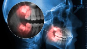 The Link Between Jaw Stiffness and Wisdom Tooth Pain Jaw Stiffness