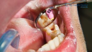 Signs You May Need a Root Canal & What Happens Next Root Canal