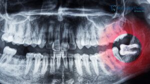 How Long Does Wisdom Tooth Pain Last After Surgery Wisdom Tooth Pain