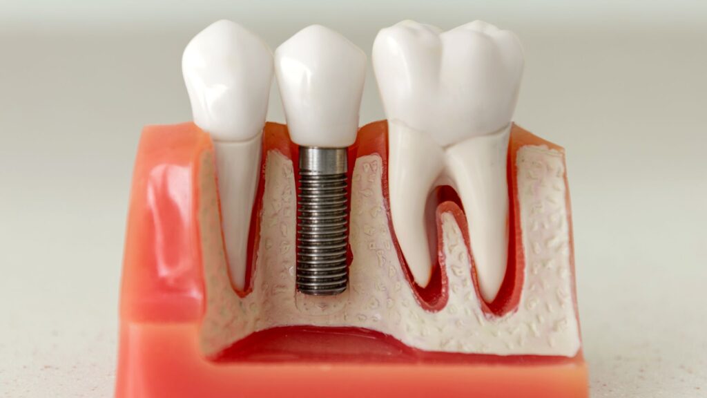 Dental Implants