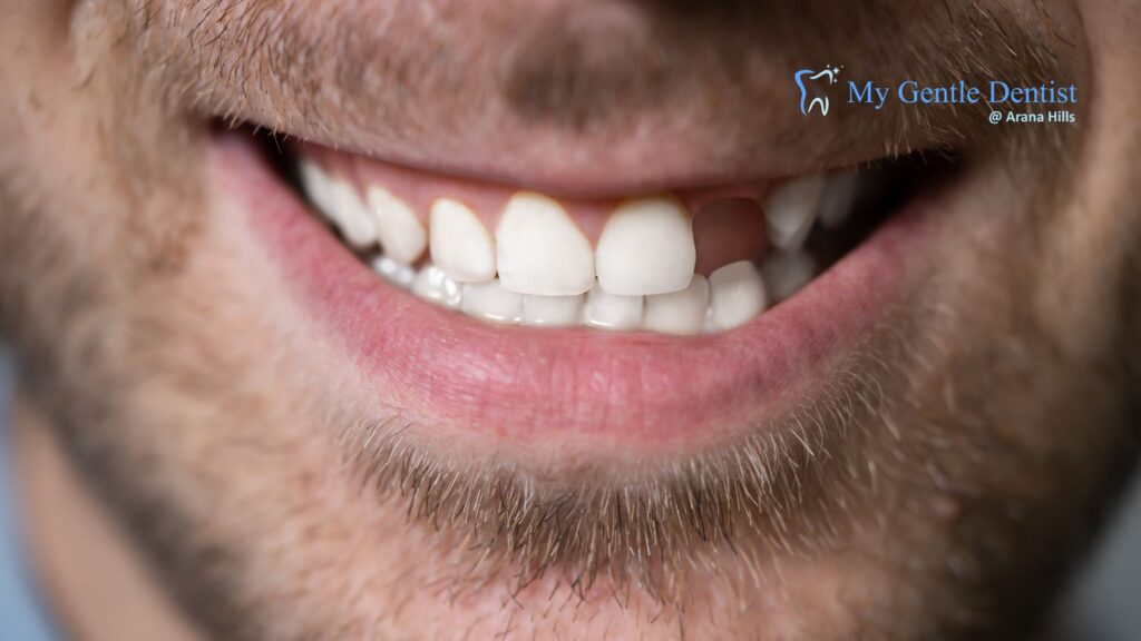 Understanding the Implant Bone Graft: The Ultimate Foundation for a Lasting Smile Implant Bone Graft