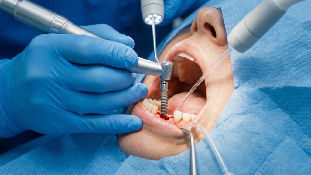 Decoding Implants Teeth Cost: Why Permanent Smiles Are the Ultimate Investment Implants Teeth Cost