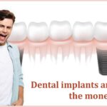 Dental Implants are worth the money spent