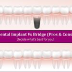 Dental Implants Vs Dental Bridges