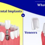 Dental Implants or Veneers – Exploring The Pros and Cons - perfect