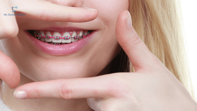 Straight Teeth Aren't Just For A Pretty Smile: Braces' Medical Benefits And How They Can Help You Straight Teeth Aren't Just For A Pretty Smile: Braces' Medical Benefits And How They Can Help You