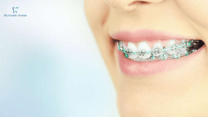 Straight Teeth Aren't Just For A Pretty Smile: Braces' Medical Benefits And How They Can Help You Straight Teeth Aren't Just For A Pretty Smile: Braces' Medical Benefits And How They Can Help You