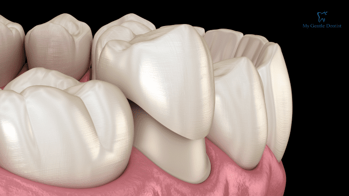 What are Dental Crowns and Bridges? Everything You Need to Know About Them