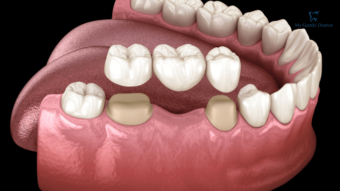 What are Dental Crowns and Bridges? Everything You Need to Know About Them