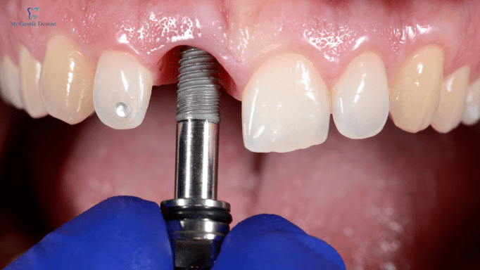 The Top 5 Reasons Why You Shouldn't Be Afraid Of Implant Surgery