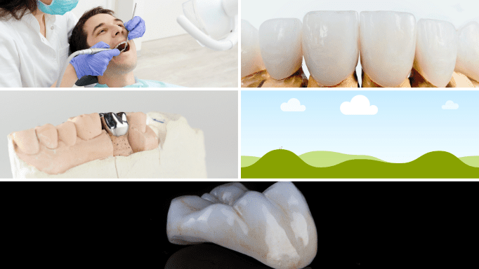 Tooth Wear: Causes, Prevention, and Treatment Tooth Wear: Causes, Prevention, and Treatment