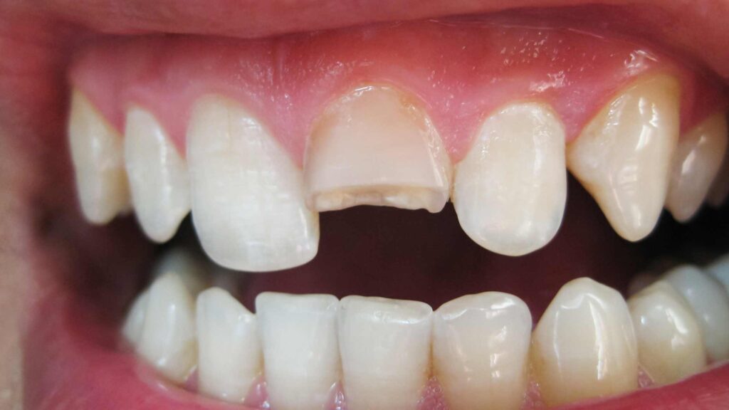 6 Crucial Times to Seek Emergency Dental Care Broken or Cracked Teeth