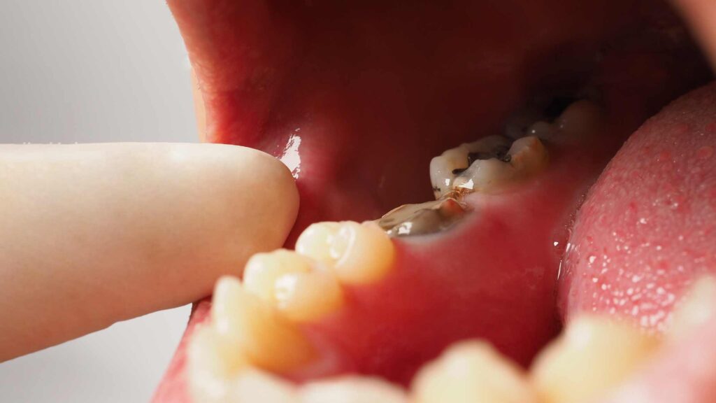 6 Crucial Times to Seek Emergency Dental Care Lost Fillings or Crowns