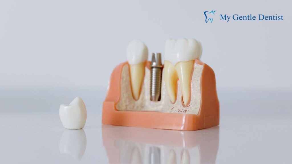 How Much Do Dental Implants Cost in Brisbane?