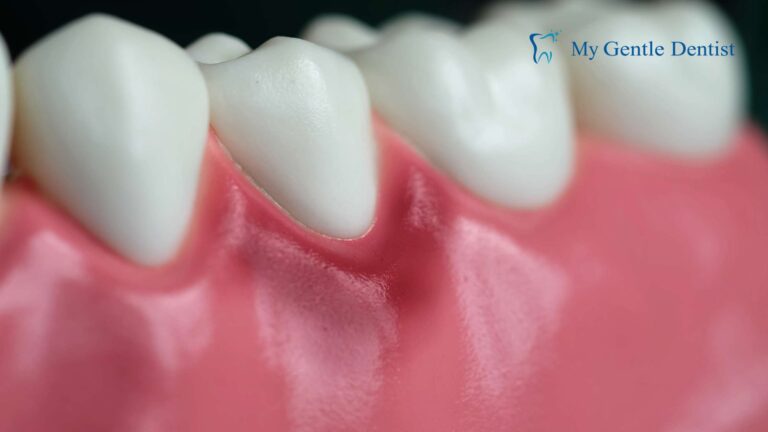 Symptoms of Gingivitis