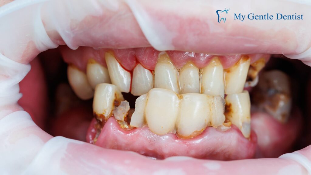 From Bad Breath to Bleeding Gums: Signs of Periodontal Disease Poor Oral Hygiene