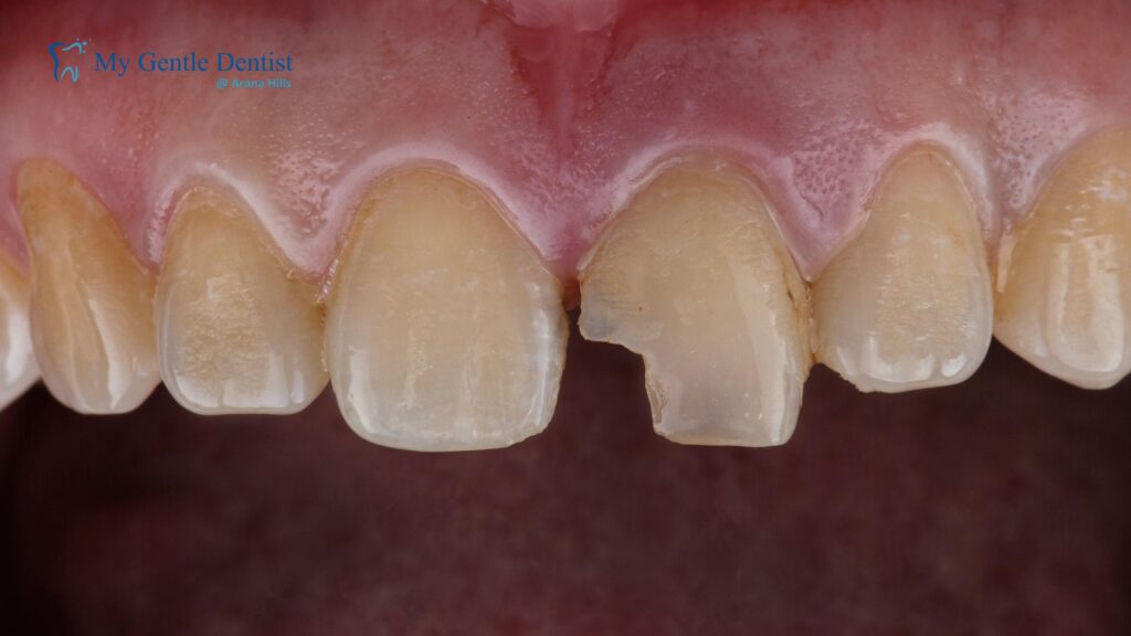 Chipped Teeth