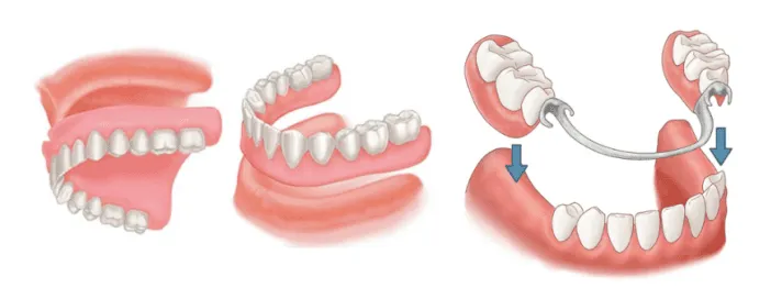 Complete/Partial Dentures