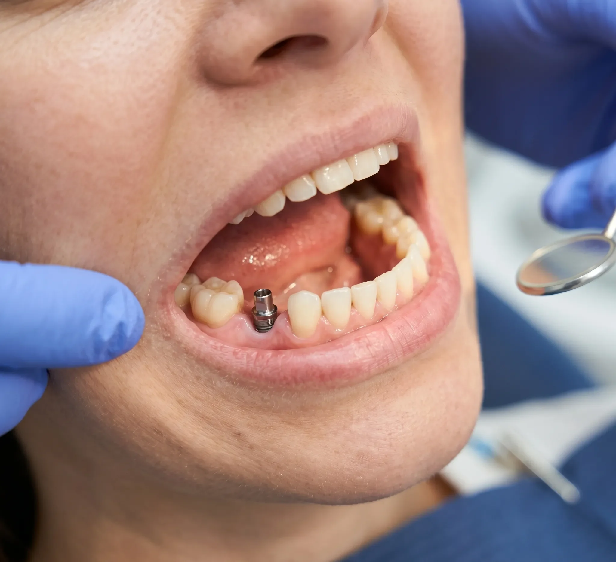 Fixed Teeth on Implants